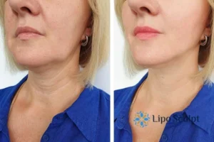 Double chin before and after Hi-Fu treatment 4 Book your double chin treatment Dunstable today! We are here to help!