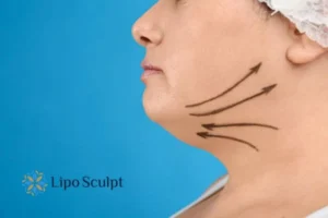 Double chin before and after Hi-Fu treatment 3 Boost your confidence with a Double chin treatment Dunstable