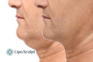 Double chin before and after Hi-Fu treatment 2 Double chin treatment Dunstable from Lipo Sculpt - feel more confident today!