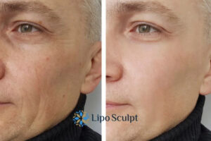 How to Fight Aging Symptoms 3 Fight Aging Symptoms Dunstable With HIFU and Morpheus8 Today!