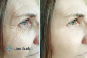 How to Fight Aging Symptoms 2 Do you want to Fight Aging Symptoms Dunstable? Contact Lipo Sculpt today!