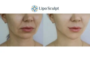 Explaining Total Skin Tightening Treatment And What It Can Do For You 2 Do you want to boost your self confidence? Give Morpheus8 Dunstable a try today!