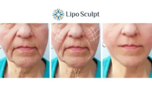 Explaining Total Skin Tightening Treatment And What It Can Do For You 3 Boost your confidence with Morpheus8 Dunstable call our team today!