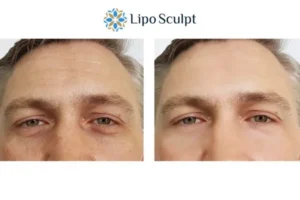 Explaining Total Skin Tightening Treatment And What It Can Do For You 6 Morpheus8 Dunstable book in today to find out more!