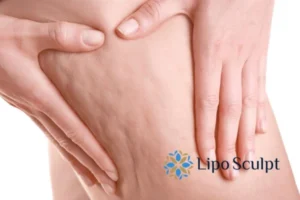 CoolSculpting for Legs: The Innovative Approach to Redefining Your Legs 5 Start your journey today book your coolsculpting treatment Dunstable online today!