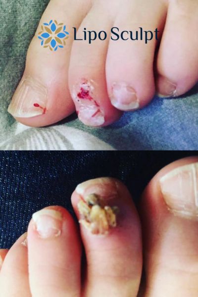 Wart removal customer results from Lipo Sculpt Dunstable