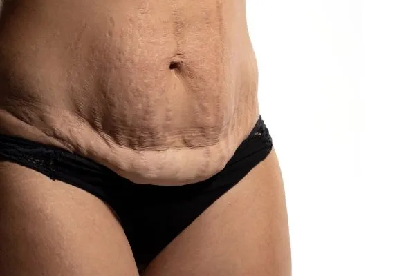 Lost the Weight but Not the Loose Skin? 1 image of womans stomach after weight loss showing loose skin Dunstable